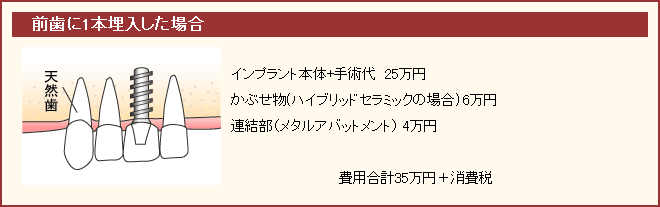 前歯に一本埋入した場合の具体例