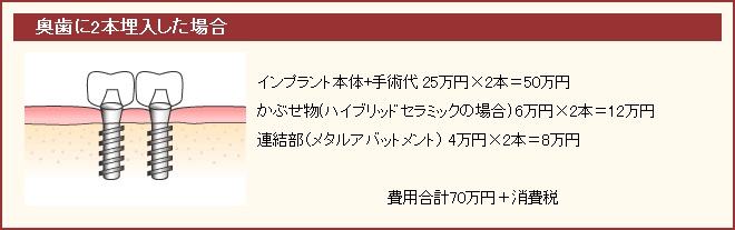 奥歯に二本埋入した場合の具体例