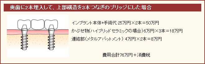 奥歯に二本埋入し、ブリッジにした場合の具体例