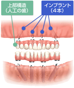 オールオンフォー All On 4 神戸インプラント総合クリニック ミント神戸15f 神戸マルイ5fの歯科医院